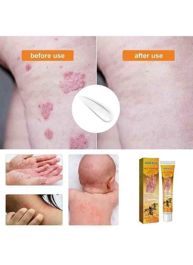 South Moon - Bee Venom Psoriasis Care Cream